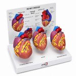 Human Heart Disease Model